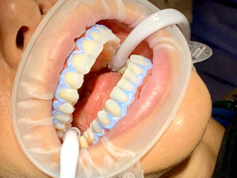 blancamiento dental