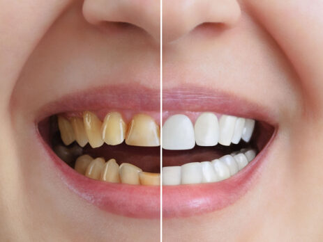 carillas dentales