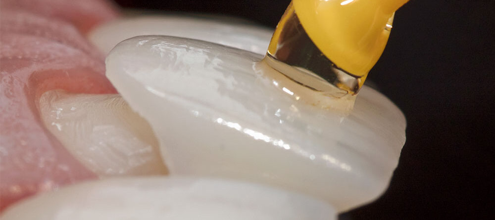 colocacion de carillas dentales