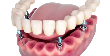 implantes dentales