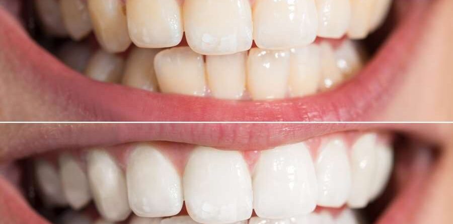 Blanqueamiento Dental