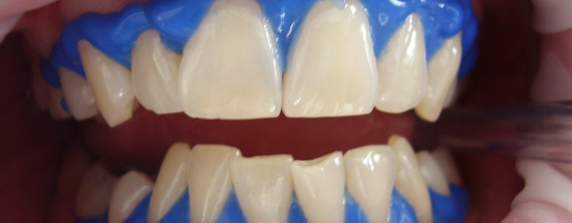 Cómo cuidar tus dientes después de un blanqueamiento dental
